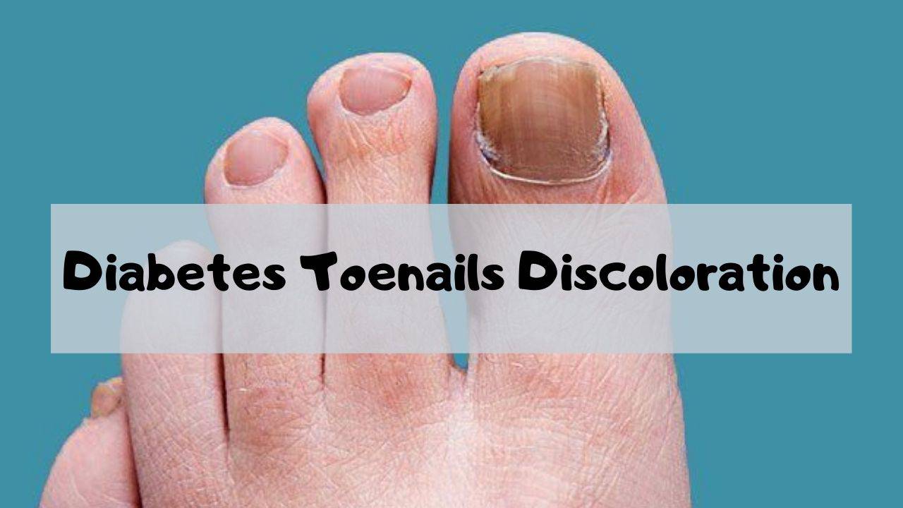 Having diabetes toenails discoloration can be an embarrassing condition for some people. It may be the beginning of a new type of condition in which they might be embarrassed about their feet and toes. Discoloration of your nails is something that is not going to just go away on its own. In fact, it is probably more common for your nails to appear darker with your diabetes. It is important to note that if you do not see this, you have probably already had diabetes toenails discoloration. Diabetes toenails may also be caused by something as simple as being overweight. If you have been overweight, your feet and toes will take up more room. The toenails will show the weight difference because they are under the surface of the skin. As your feet get heavier, so will your nails. If you already have diabetes toenails, then you may need to learn how to eliminate this condition with diet, exercise and some type of medication. Because nail fungus is usually a problem that results from diabetes, it is also likely that you may not want to put on any type of polish to your nails, even if it is very expensive. If you have been diagnosed with diabetes toenails, you might not want to worry about the cost of your nail polish because there are many other things that you can buy and many different types of manicures and pedicures that you can schedule for yourself. This is not to say that if you have diabetes toenails that you will have to take care of them yourself, but the fact remains that you have a medical condition and you are expected to pay attention to it and take care of it. With diabetes toenails, the root cause of the problem can often be attributed to the fact that your nail fungus may have grown in the moist areas of your feet. Nail fungus thrives in dark, warm places. Since diabetes toenails are affected by nail fungus, these areas of the foot are prime areas for this fungus to grow. Diabetes toenails can be caused by many different conditions and issues. These include things like diabetes itself, heredity and pregnancy. It is also possible that the fungus that causes diabetes toenails has spread to the skin in other parts of the body that also contain nail. When a nail fungal infection gets into the nail itself, the nail itself becomes infected and can eventually lead to toenail discoloration. People who suffer from diabetes toenails, or problems with nail fungus, should try to get these issues treated early on so that the condition does not get out of control. People who are really healthy might think that having toenails that look yellow is simply normal. Many people who have diabetes toenails may have a hard time believing that having yellow toenails is embarrassing, but the truth is that the appearance of the yellow toenails is a result of toenail discoloration. Nail discoloration can actually be caused by many different things, including diabetes toenails. Diabetes toenails discoloration can also be caused by eating a lot of food that contains too much sugar in it, and it can also be caused by a variety of different medications. It is important for people who have diabetes toenails to remember that they have a problem that needs to be taken care of in order to improve their health. By learning what causes diabetes toenails discoloration, they can begin to look into what causes the problem and possibly treat it. They can also learn how to find ways to help treat their condition, as well as how to prevent further diabetes toenails discoloration